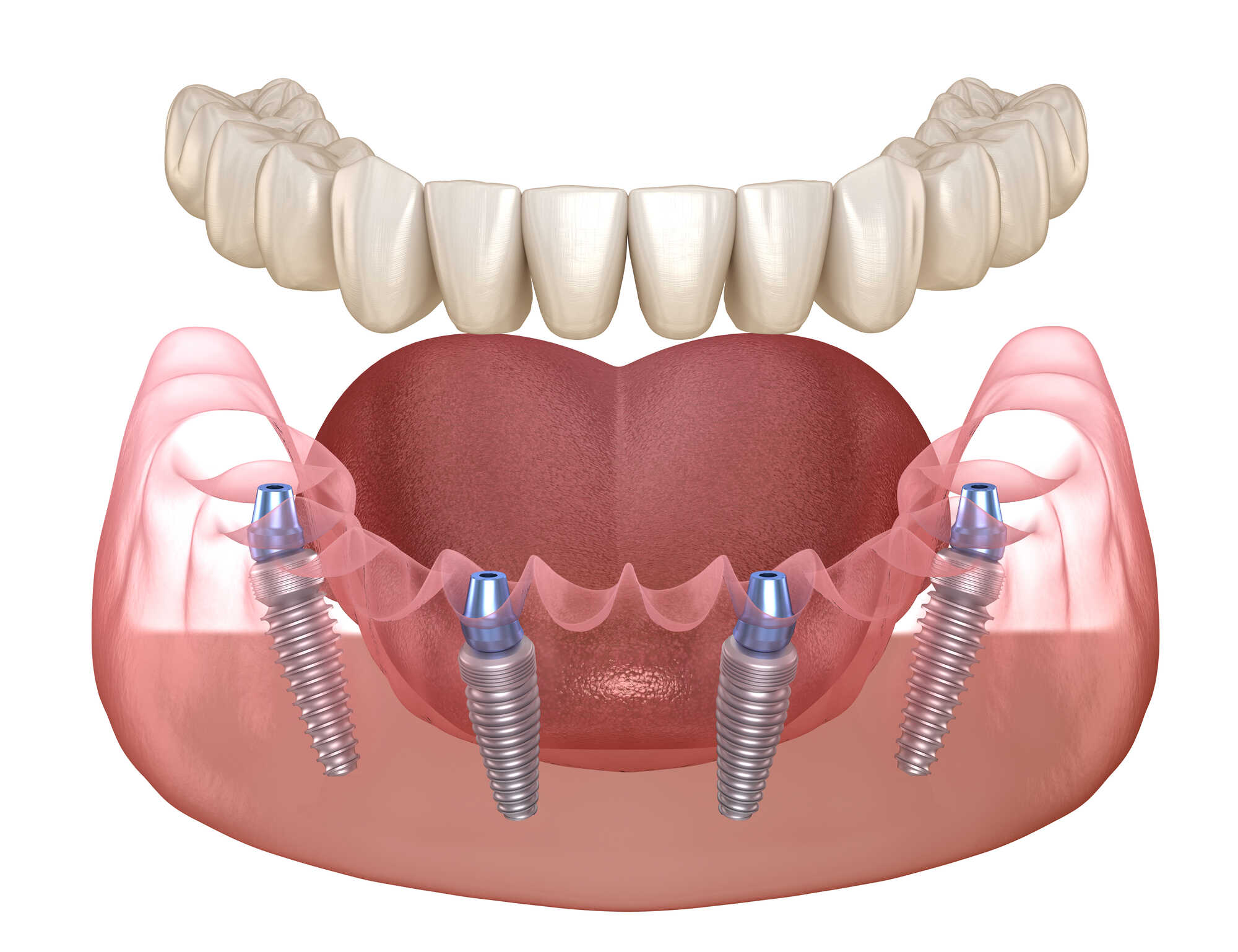 mandibular-prosthesis-all-on-4-system-supported-by-implants_optimized.-medically-accurate-3d-illustration-of-human-teeth-and-dentures-concept