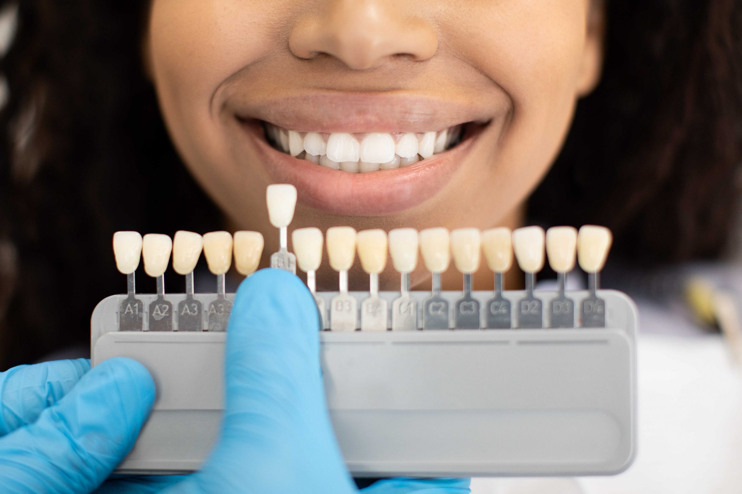 unrecognizable-dentist-in-sterile-gloves-holding-dental-teeth-shade-guide-chart,-choosing-right-emanel-color-for-black-female-patient-during-whitening-treatment-in-downers-grove-il